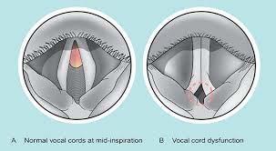 Vocal Cord