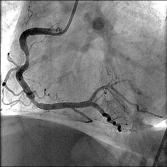 Current guidelines support culprit vessel PCI only Contemporary