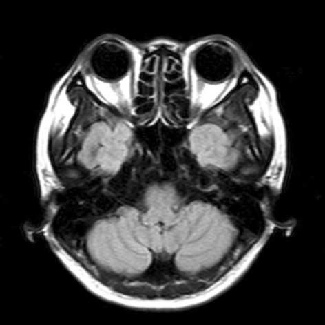 A brain CT showed cystic lesions at bilateral petrous apex (Fig. 2A).