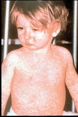 Measles - global Since 2000 vaccination has led to 75% drop in deaths prevented 15.