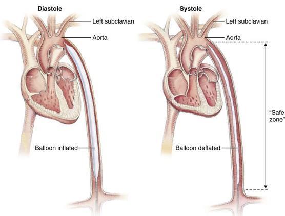 Intra-Aortic