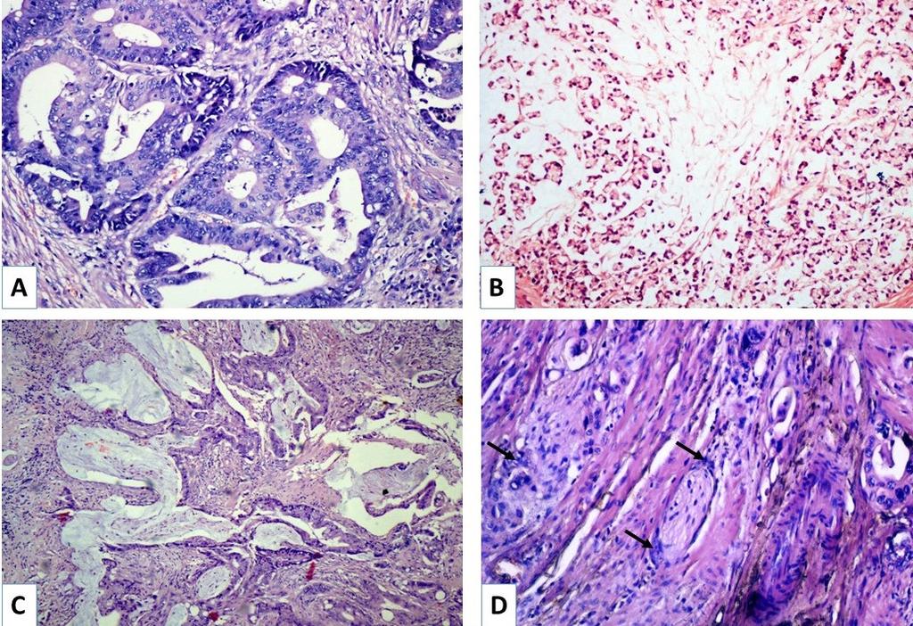 A-144 D2-40 Expression in Colorectal Carcinomas Out of 40 cases studied, 8 (20%) showed perineural invasion. Amongst them, 6 cases were moderately differentiated and 2 were poorly differentiated.