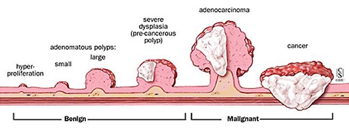 95-98% of colon cancers - adenocarcinoma Most originate in polyps or adenomas But, only 10% of adenomas develop into cancers Types of adenoma Tubular Villous Tubulo-villous Process takes up to 10