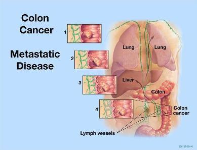 Lung Liver Lymph Nodes Seeding in peritoneum Seeding of small intestine www.colorectal-surgeon.