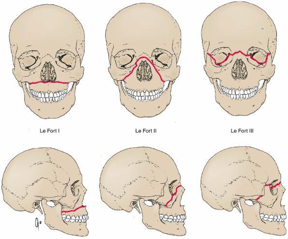 Maxillofacial Fractures Maxillofacial fractures usually occur as the result of massive facial trauma.