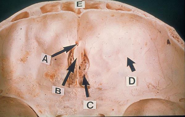 Anterior Cranial Fossa The floor of the fossa is formed by: The ridged orbital plates of the frontal bone laterally The cribriform plate of the ethmoid