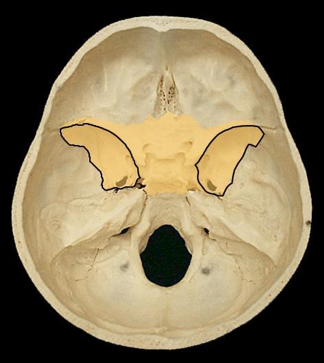 Fractures of the Middle Cranial Fossa Fractures of the middle cranial fossa are common, why? The leakage of cerebrospinal fluid and blood from the external auditory meatus is common.