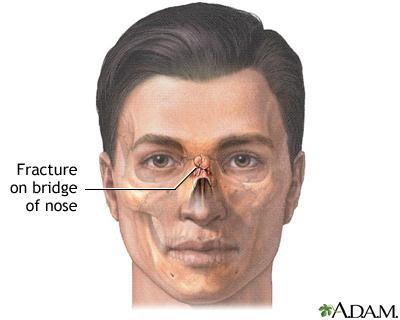 Nasal Fractures Fractures of the nasal bones, because of the prominence of the nose, are the most