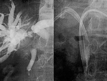 Fig. 2. A 70-year-old woman with hilar cancer. Initial cholangiography shows hilar obstruction (A).