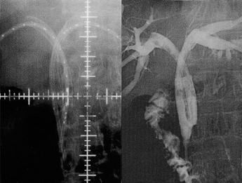 Two iridium-192 wires were placed through guiding catheters for intraluminal brachytherapy (C). After cholangiography, tubes were removed (D).