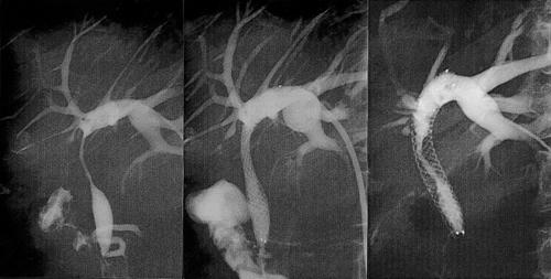 A B C Fig. 4. A 54-year-old woman without hilar involvement. Initial cholangiography shows occlusion of common hepatic duct (A).