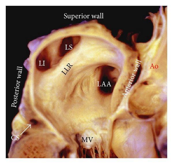 LA Images Longitudinal section through the heart Floor - Mitral Valve Roof = superior wall ( atrial dome ) Posterior wall = adjacent to the LIPV.