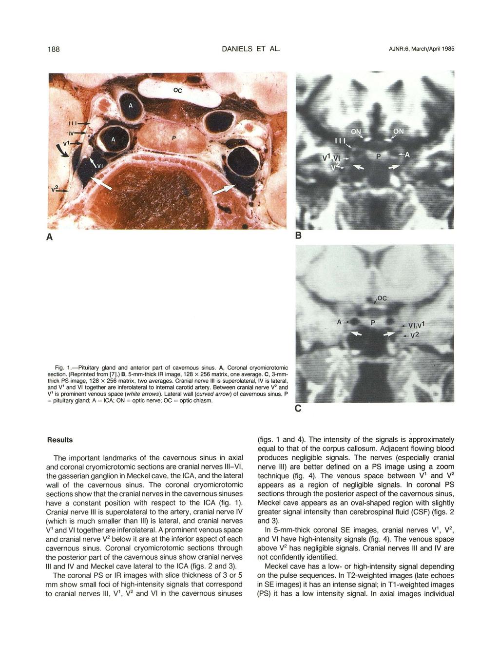 188 DNIELS ET L. JNR :6, Marh/pril 1985 Fig. 1.-Pituitary gland and anterior part of avernous sinus., Coronal ryomirotomi setion. (Reprinted from [7].