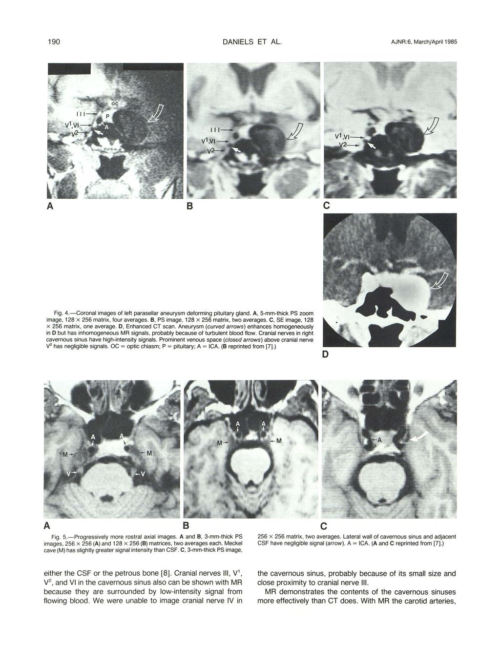 190 DNIELS ET L. JNR:6, Marh/pril 1985 Fig. 4.-Coronal images of left parasellar aneurysm deforming pituitary gland., 5-mm-thik PS zoom image, 128 x 256 matrix, four averages.