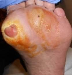 Case 15 Patient with Recurrent Deep Left Foot Plantar DFU that Probed to Bone This 81-year patient was referred to the Complex Wound Clinic by Infectious Disease Specialist in August 2016 for TCC