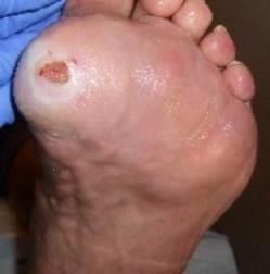 The patient later discharged himself from HCN when he chose to have his left foot plantar DFU treated by his podiatrist.