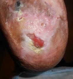 His right heel DFU deteriorated rapidly with deep wound infection requiring IV antibiotics. He was admitted to acute care for revascularization in July 2016.