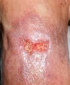 Case 6 Patient with Chronic Right Foot Dorsal Ulcer with Intolerance to Compression The patient was a 58-year old patient.