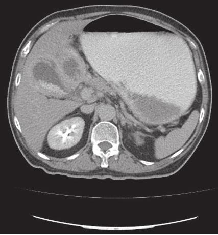 CASE REPORT A 62-year-old male with a two-month history of right upper quadrant pain associated with nausea and vomiting causing 40 pounds weight loss.