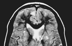 Commonly misdiagnosis as MS, cerebral vasculitis,