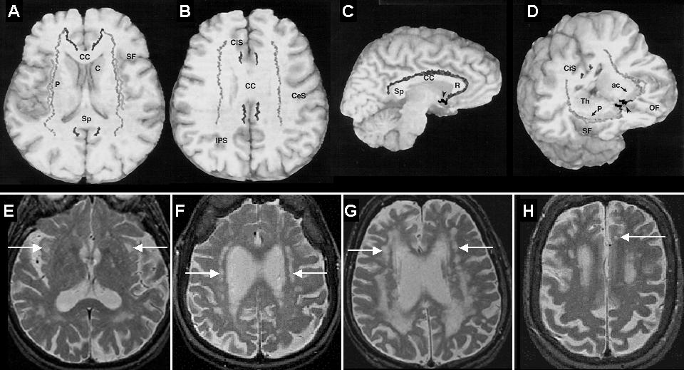Cholinergic projections from nbm Axial MRI of patient IV.