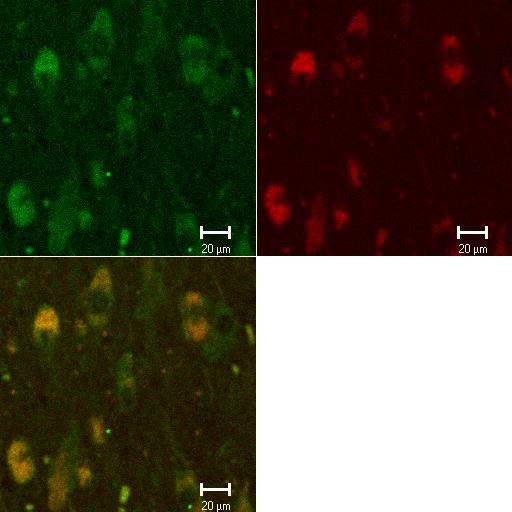 CADASIL and Cholinergic neuronal pathology nbm cells- CADASIL