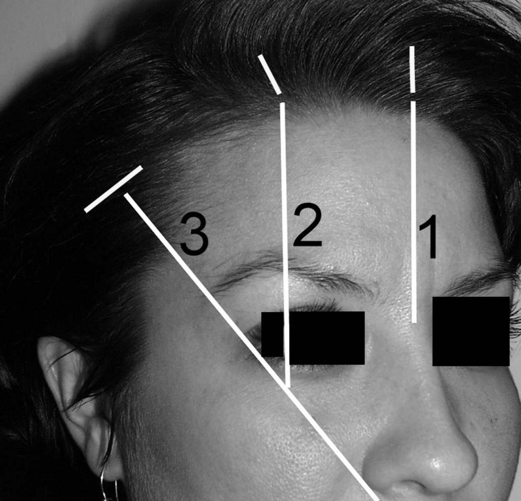 146 S.W. Watson et al / Atlas Oral Maxillofacial Surg Clin N Am 11 (2003) 145 155 Fig. 1. The positions of the incisions for the endoscopic brow lift are illustrated by the yellow lines.