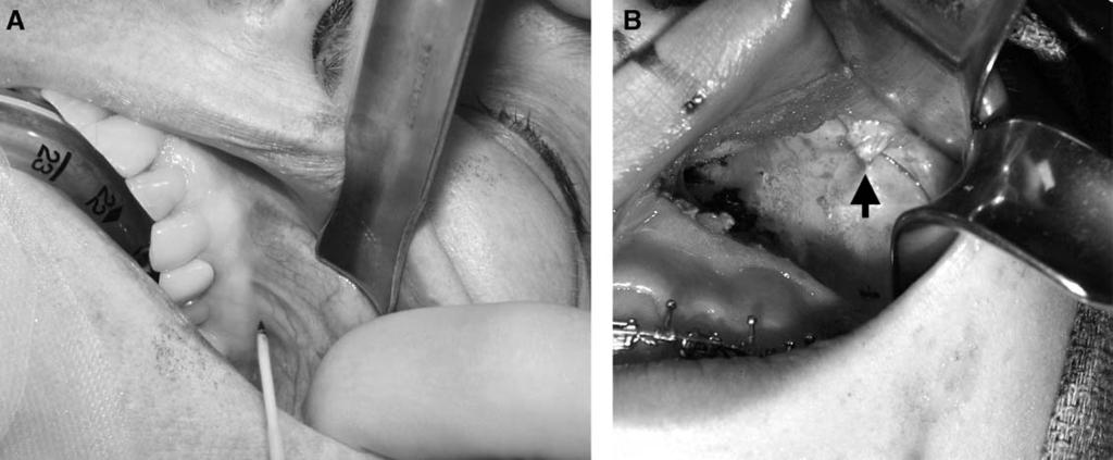 S.W. Watson et al / Atlas Oral Maxillofacial Surg Clin N Am 11 (2003) 145 155 147 Fig. 2.