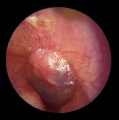 2. Acute Otitis Media Description: Shortly after, a creamy white purulent effusion can be seen collecting in the middle ear.