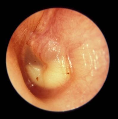 Perforated Otitis Media - Description: This adult who has a long-standing perforation in the right tympanic membrane developed an acute