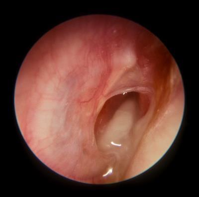 4. Acute Otitis Media Description: This is the stage of resolution.