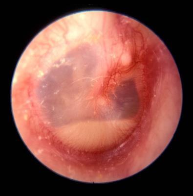 Note the air fluid level, and collection of white and presumably sterile exudate in the inferior third of the middle ear.