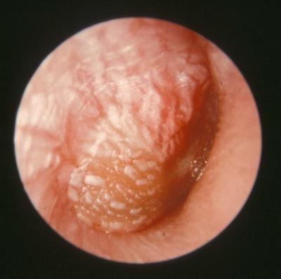 6. Acute Otitis Media Description: This patient presented with an acute otitis media in the stage of suppuration.