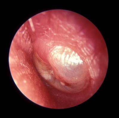 There is a moderate outward bulging of the eardrum. 7.