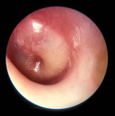 8. Advanced Suppurative Otitis Media Description: The infection in the middle ear may extend into the tympanic membrane causing infection and necrosis with rupture of the