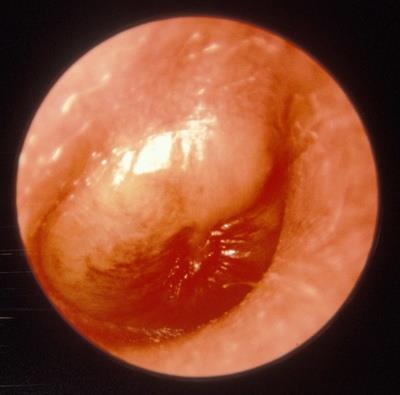 Severe Acute Otitis Media Description: The infection in the middle ear may spread into the fibrous middle layer of the tympanic membrane causing necrosis of a portion of