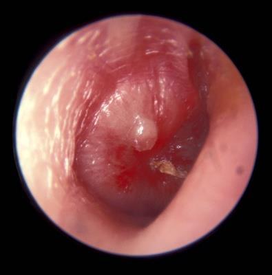 of necrosis and the pressure of the purulent effusion within the middle ear has caused the epithelium to bulge laterally. This is the area through which a perforation will shortly develop. 10.