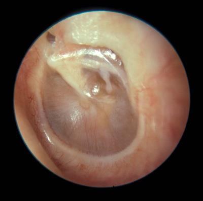 middle ear. At first glance, this tympanic membrane appears to be normal; however, on careful inspection it is apparent that the middle ear is filled with a Grey fluid.