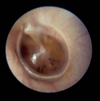 12. Serous Otitis Media Description: Serous otitis media is characterized by the presence of a thin straw colored clear transudate in the middle ear.