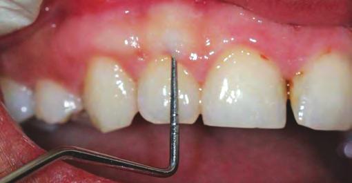 IJoLD Erbium Laser-assisted Closed-flap Crown Lengthening: A Review of the Literature Periodontal Health The probing depth in the area should be within the healthy limits.