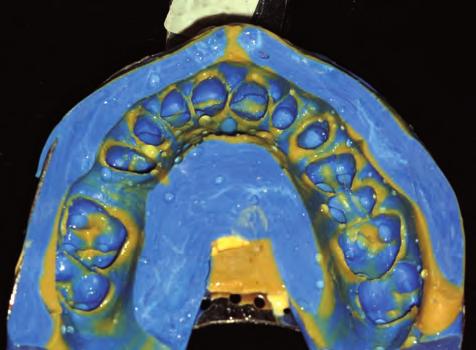 Urmi Bhattacharyya et al lasers for osseous recontouring only in very localized or minor cases, such as one surface of a tooth.