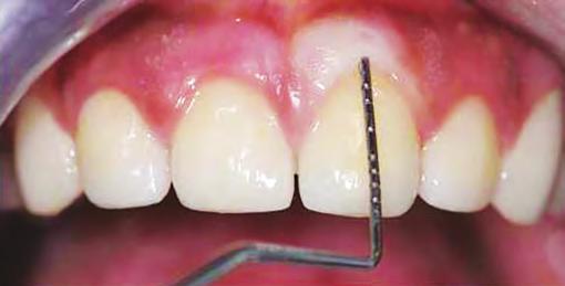 Dyer recommends reflection of the gingival papilla in cases of circumferential bone resection.
