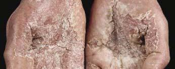 Dermatitis Atopic