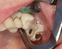 Extraction with Immediate Implant Placement and Ridge Preservation in the Posterior CASE REPORT A 61-year-old female presented to the practice with symptomatic maxillary left first
