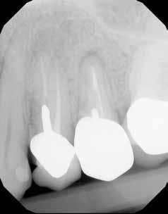 Endodontic evaluation indicated fractures and a poor prognosis for further treatment of the teeth (Fig. 2). The patient reported controlled hypertension and anemia.