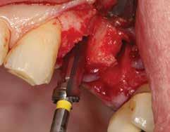 Extraction with Immediate Implant Placement and Ridge Preservation in the Posterior 13a Figure 9: A 4.