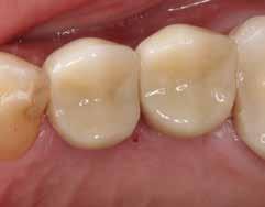 Extraction with Immediate Implant Placement and Ridge Preservation in the Posterior the healthy, grafted implant site (Figs. 21a 21c).