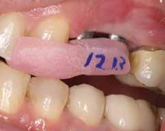 CONCLUSION The most important aspects of immediate implant placement and eventual final esthetic reconstruction can be summarized as follows: 1 Minimize