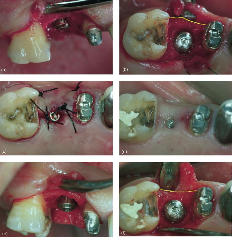 822 Botticelli et al. Fig. 1. Clinical photographs describing the implant site of patient L. C. immediately after implant installation: (a) buccal view and (b) occlusal view, (c) follow flap closure with sutures and (d) after 4 months of healing.