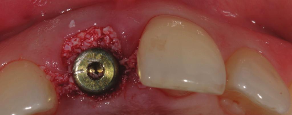 Immediate Implant Placement: Parameters Influencing Tissue Remodeling Bernard Touati, DDS and Mario Groisman, DDS In esthetic implant therapy, the patient s objective is to obtain an